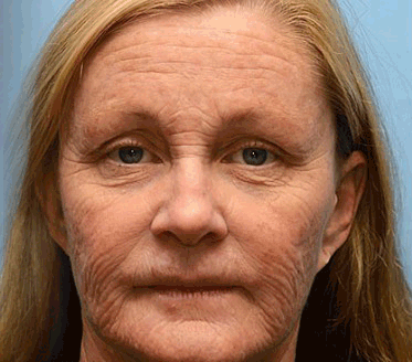 (🐝Made and Shipped from USA✅)  Botox Bee Venom Wrinkle Removal Cream- LAST DAY 70% OFF